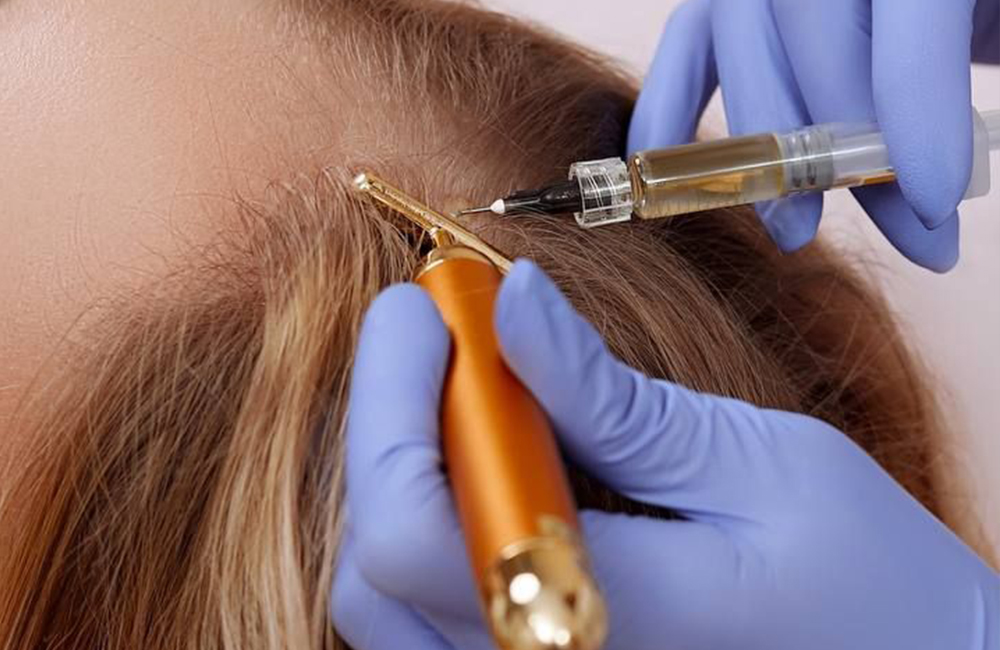 mesoterapia capilar