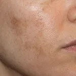 estrés rostro