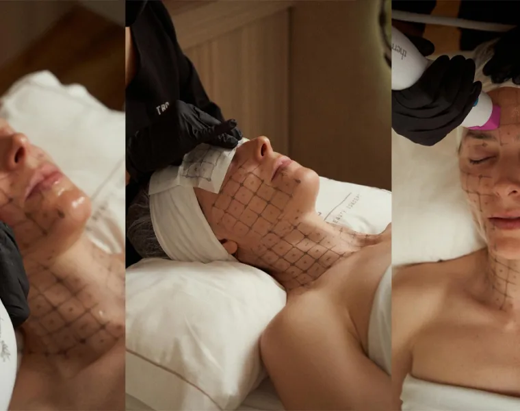 thermage flx rostro