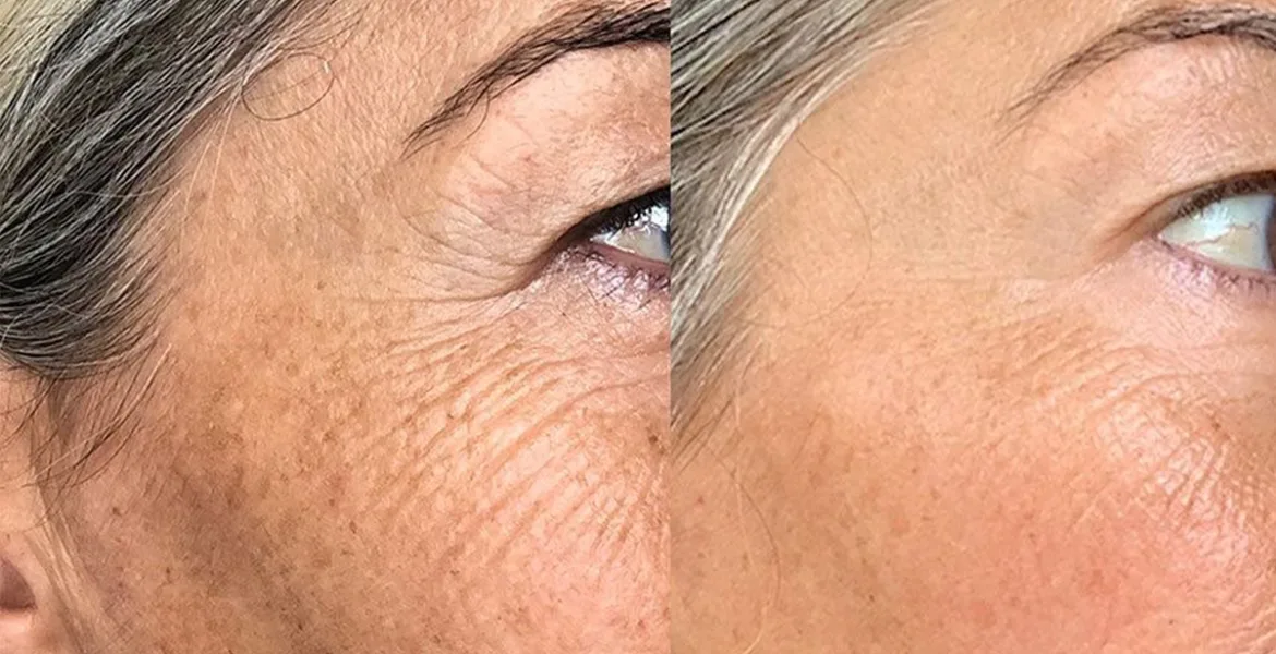 polinucleotidos ojeras