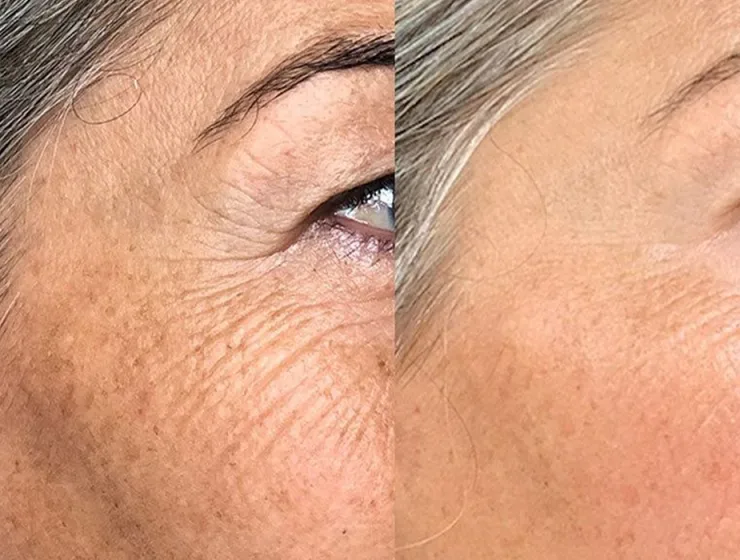 polinucleotidos ojeras