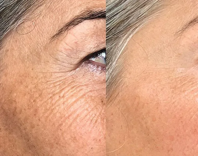 polinucleotidos ojeras