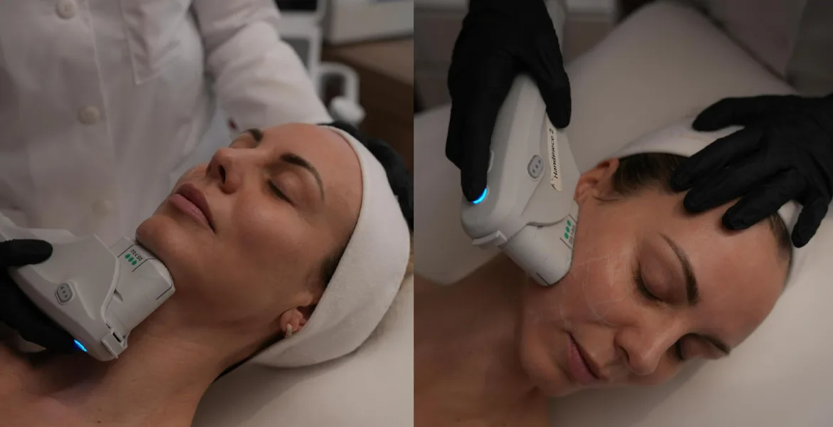 ultherapy prime