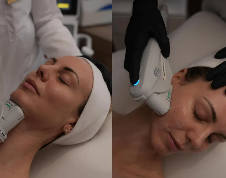 ultherapy prime