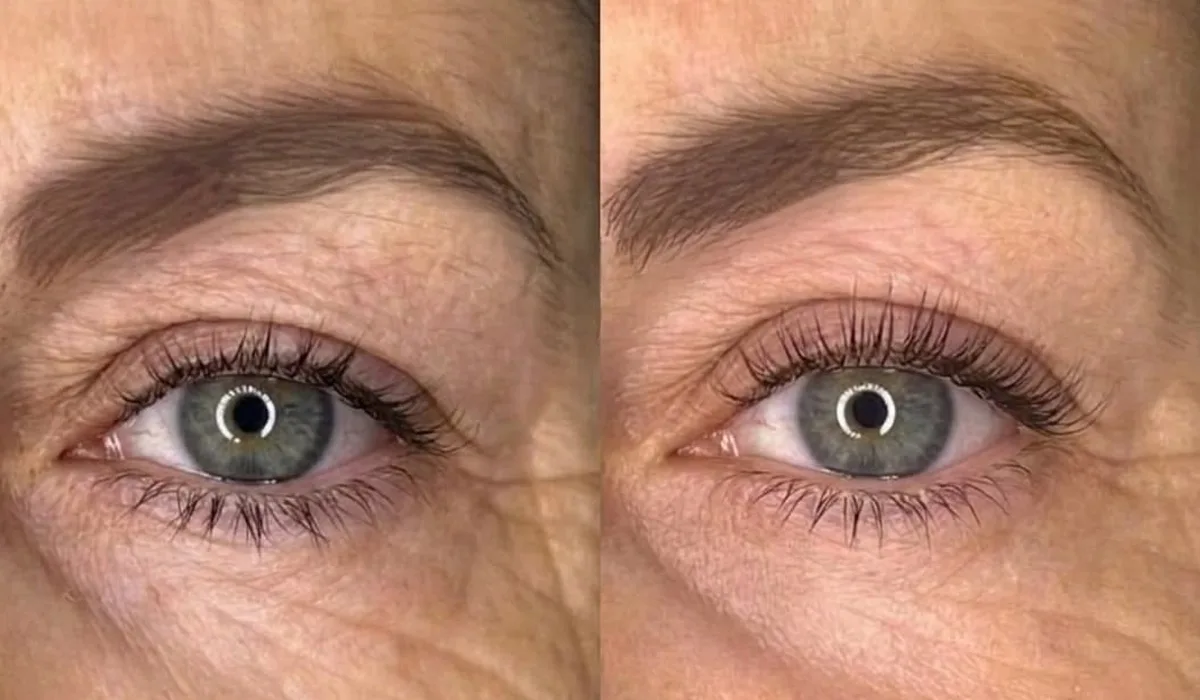 radiofrecuencia facial