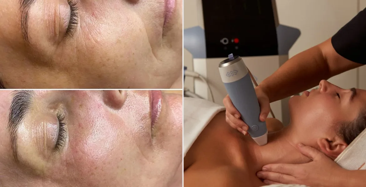 radiofrecuencia facial