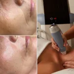 radiofrecuencia facial