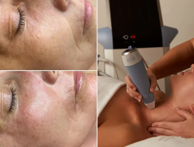 radiofrecuencia facial