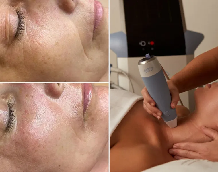 radiofrecuencia facial
