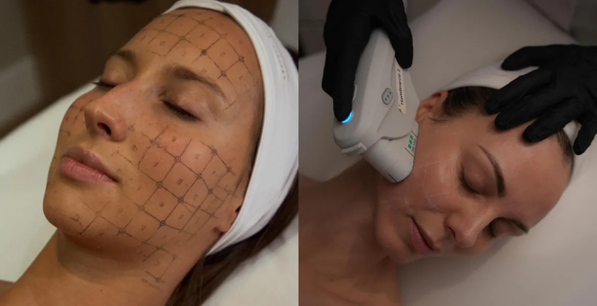 ultherapy prime y thermage flx