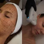 ultherapy prime y thermage flx