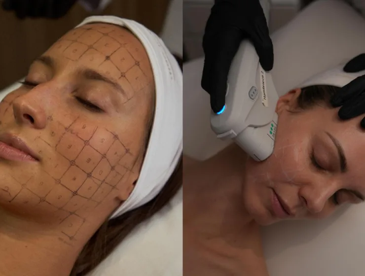 ultherapy prime y thermage flx