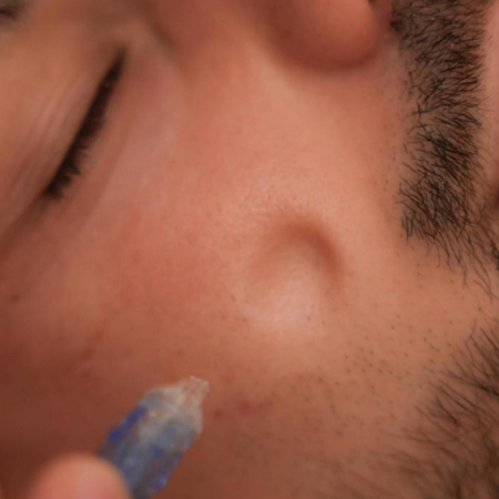 Tratamiento facial JetPeel