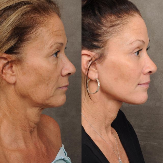 ULTHERAPY COMPARACION 2