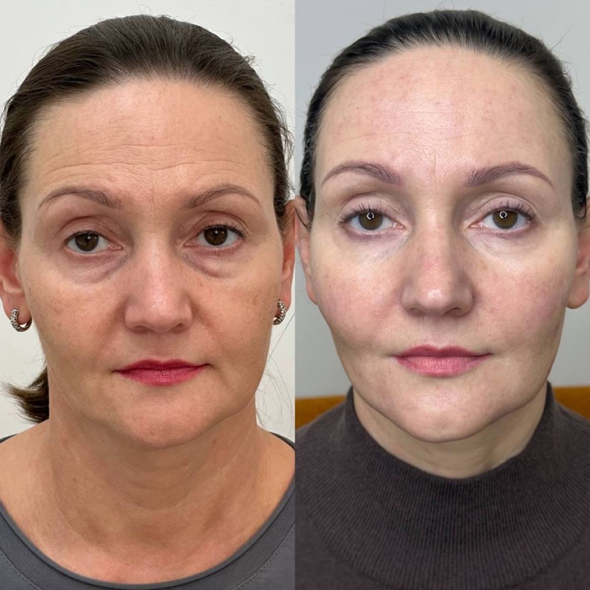 ULTHERAPY COMPARACION 3