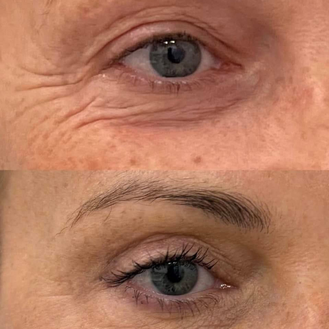 ULTHERAPY COMPARACION