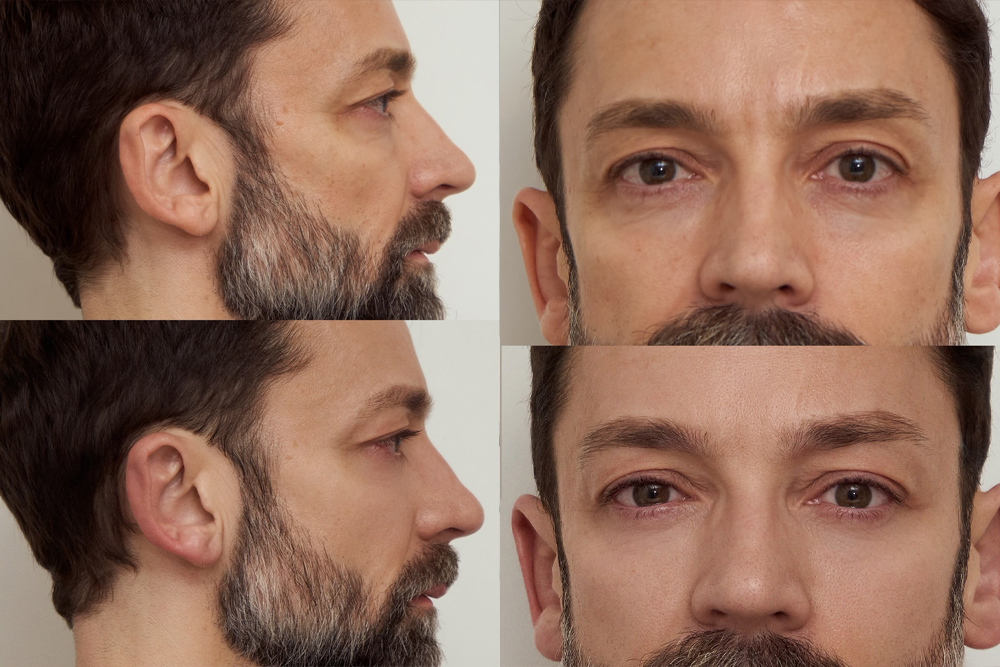 thermage flx ojos hombres